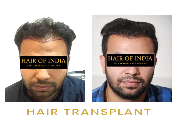 Hair of India | Hair Transplant in Ludhiana